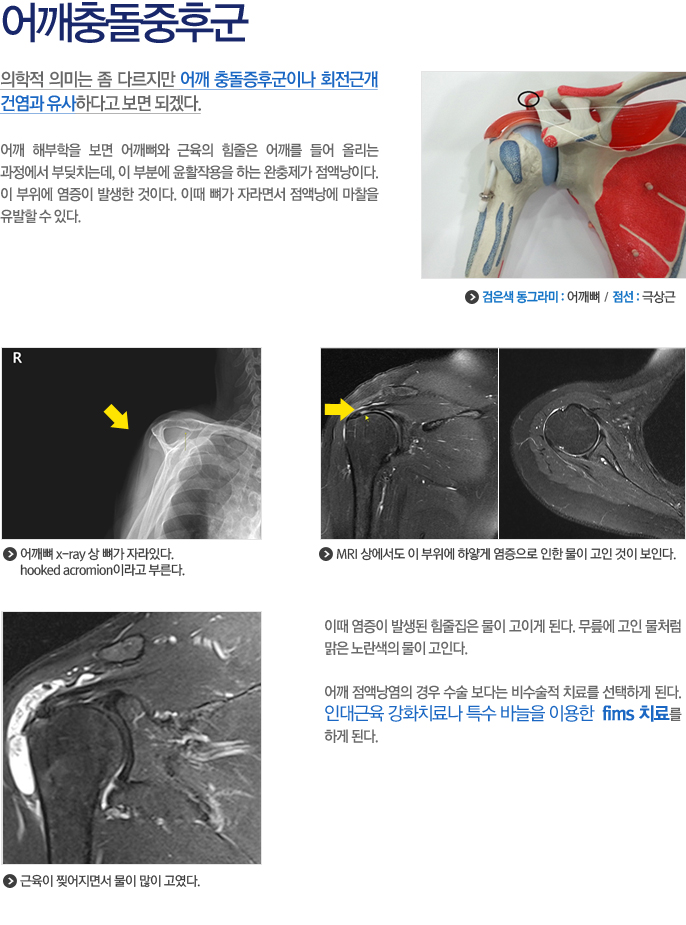 어깨충돌증후군