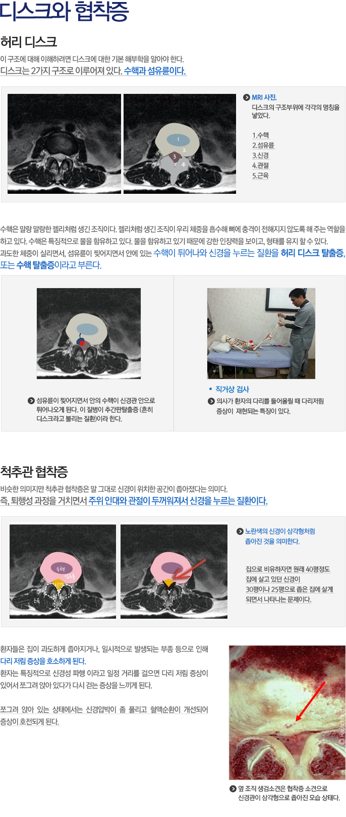 디스크와 협착증